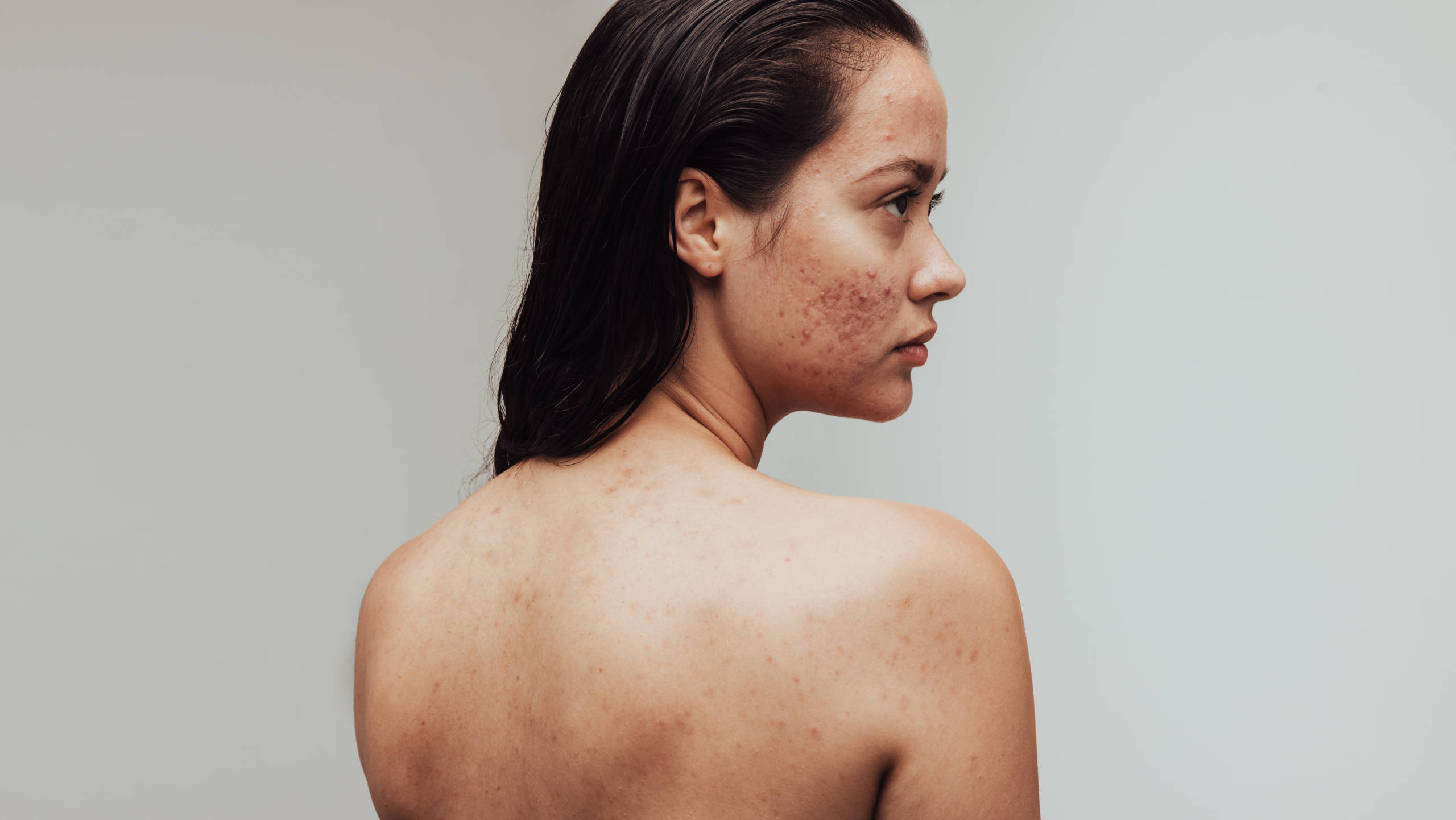 Acne Scar Treatment NZ